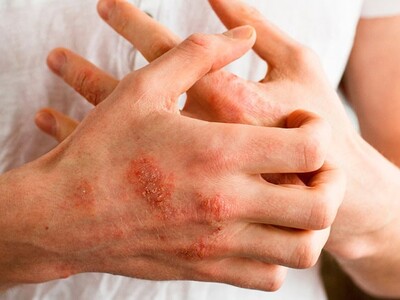 ¿Cómo evitar la dermatitis atópica?